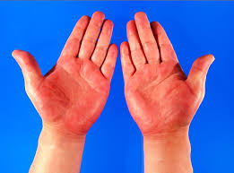 red rashes on hand #10